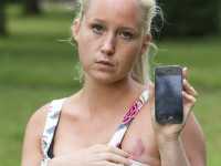 英国女子抱iPhone入睡 胸部被灼伤